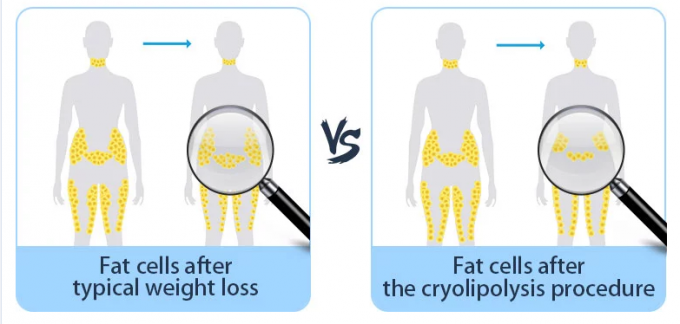 Gelata grassa di Cryolipolysis che dimagrisce riduzione a macchina delle celluliti e di circonferenza