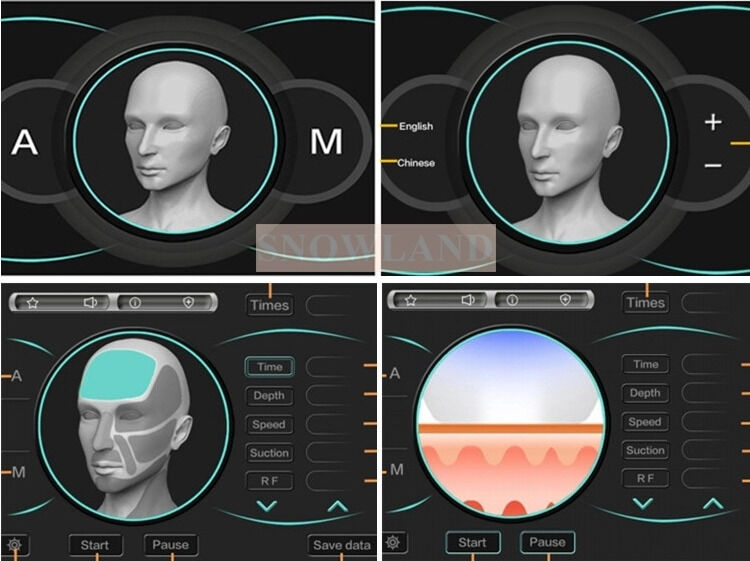 Macchina per la depilazione laser a diodo laser a semiconduttore da 808 nm con sensore a contatto con la pelle che garantisce un trattamento di depilazione rapido